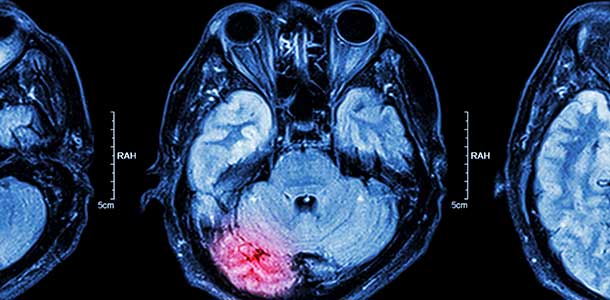 Scans of brain highlighting mass