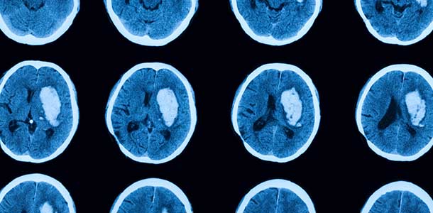 CT scan of brains highlighting a tumor